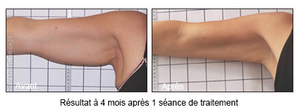 Relâchement de la peau des bras