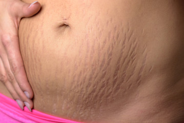 Vergetures de grossesse